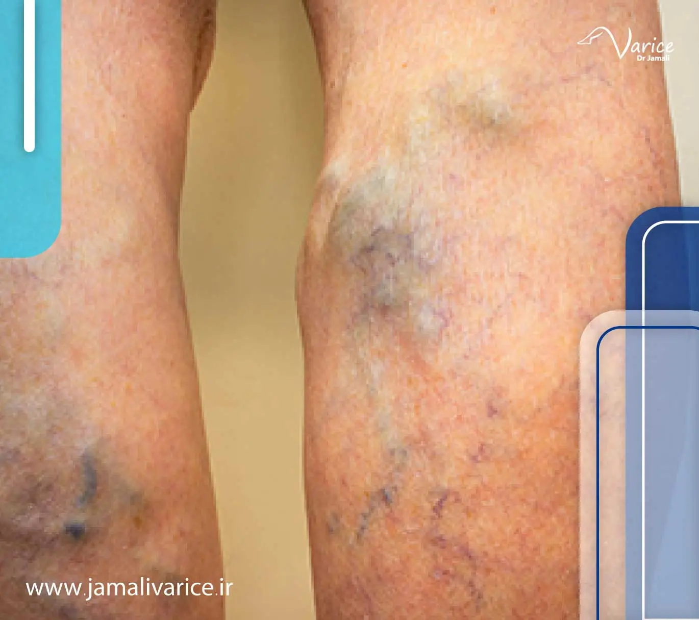 varicose veins