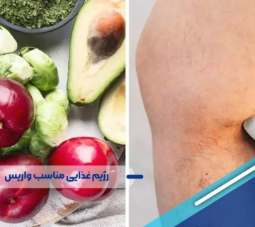 رژیم غذایی مناسب واریس