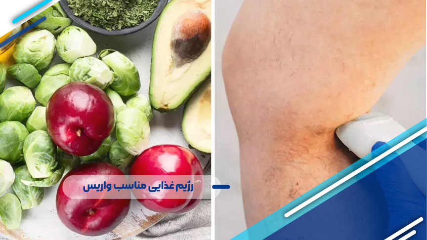 رژیم غذایی مناسب واریس